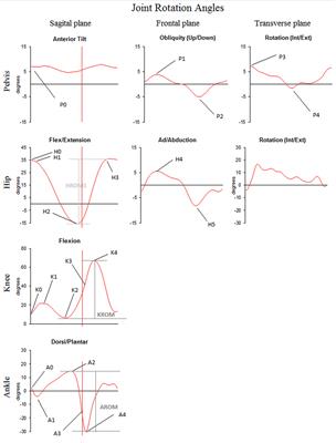 Playing Music May Improve the Gait Pattern in Patients with Bilateral Caloric Areflexia Wearing a Cochlear Implant: Results from a Pilot Study